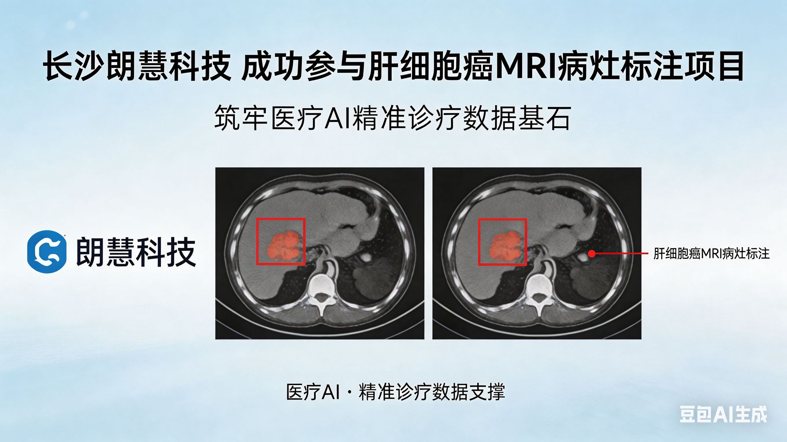 长沙朗慧科技参与肝细胞癌MRI病灶标注项目新闻稿.png