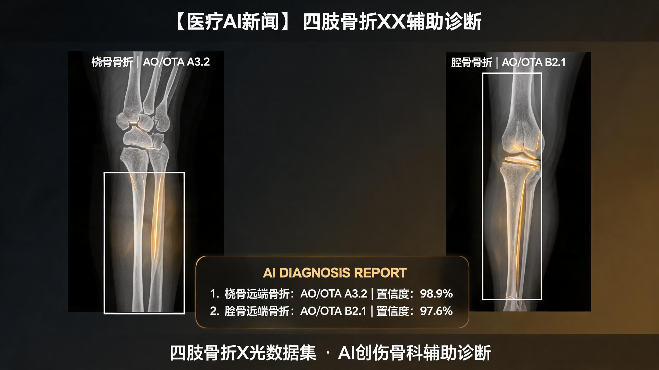 急诊骨科的AI加速度：180万例四肢骨折数据与42类AO/OTA分型全覆盖