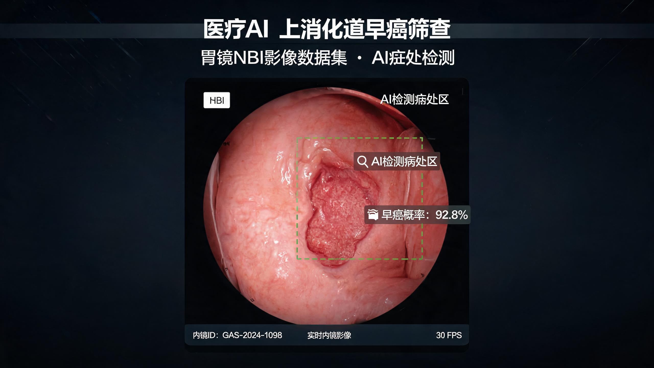 上消化道早癌筛查的中国方案：15万例胃镜数据集与NBI多模态融合突破